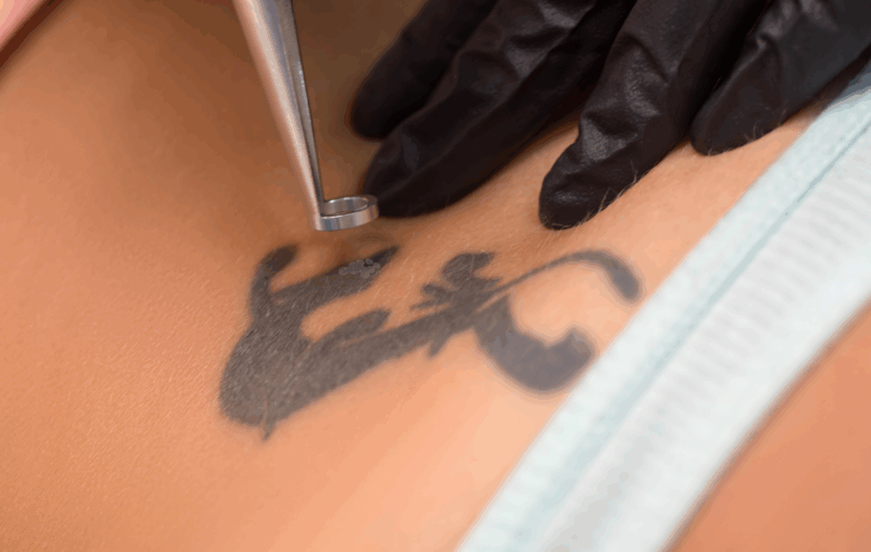 retirer tatouage laser