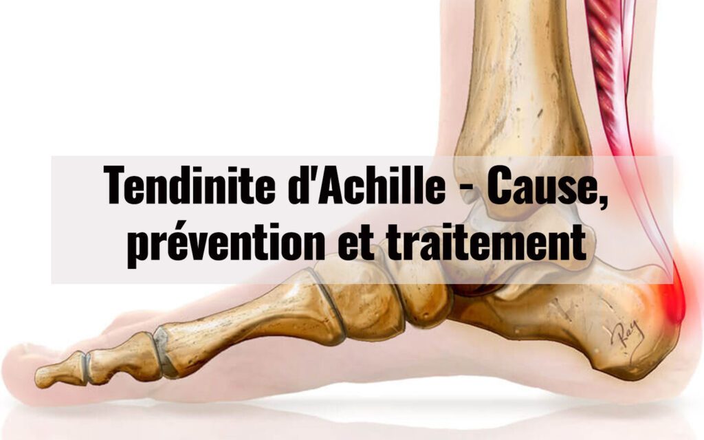 Bursite du tendon d’Achille : comment la kinésithérapie peut soulager la douleur
