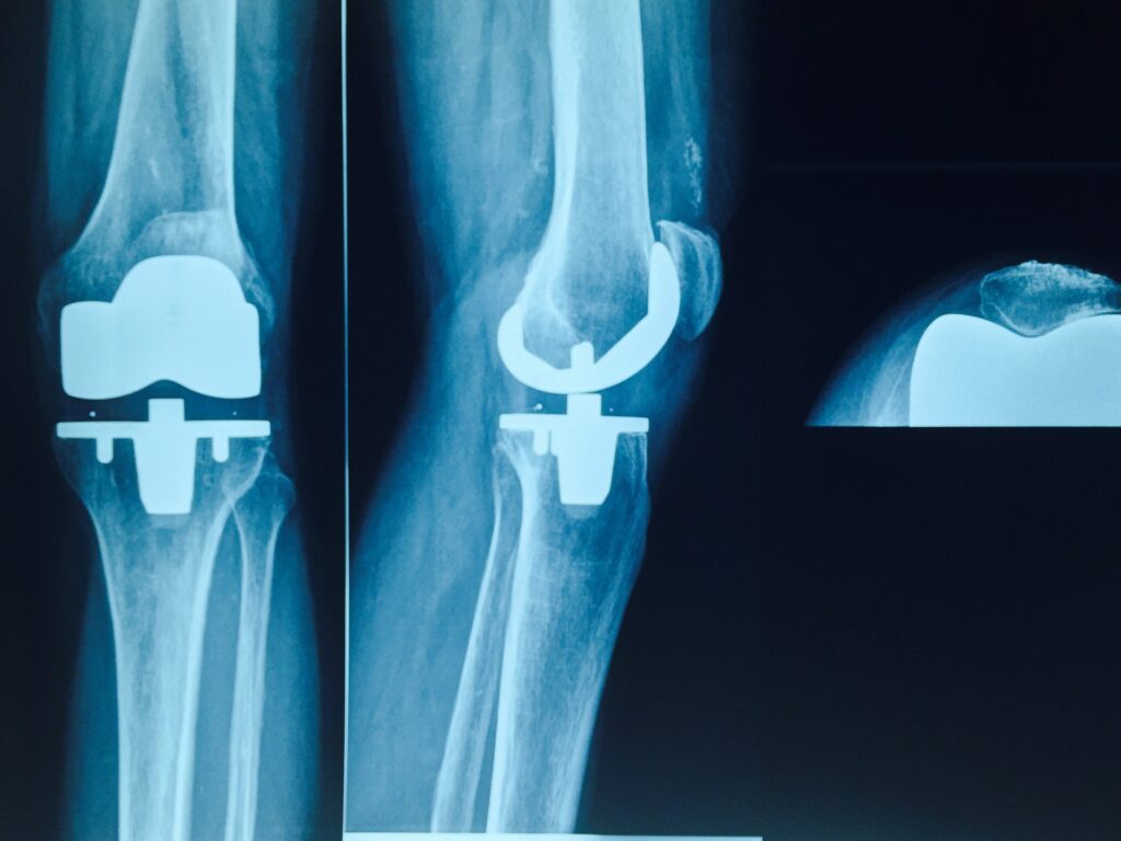 Conflit sous-acromial : stratégies de rééducation kinésithérapique pour une récupération optimale