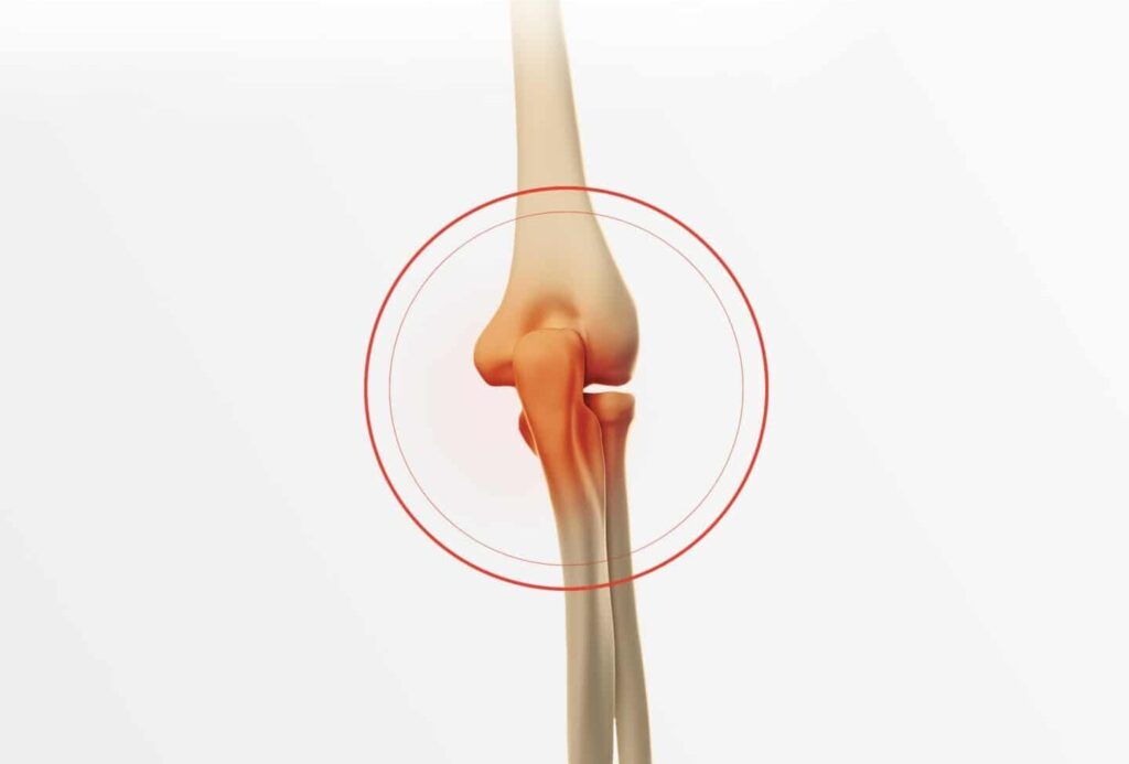 Fracture de l’avant-bras : symptômes, traitements et récupération