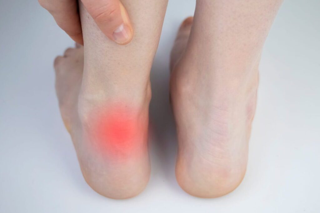 Tendinopathie calcanéenne : symptômes, causes et traitements
