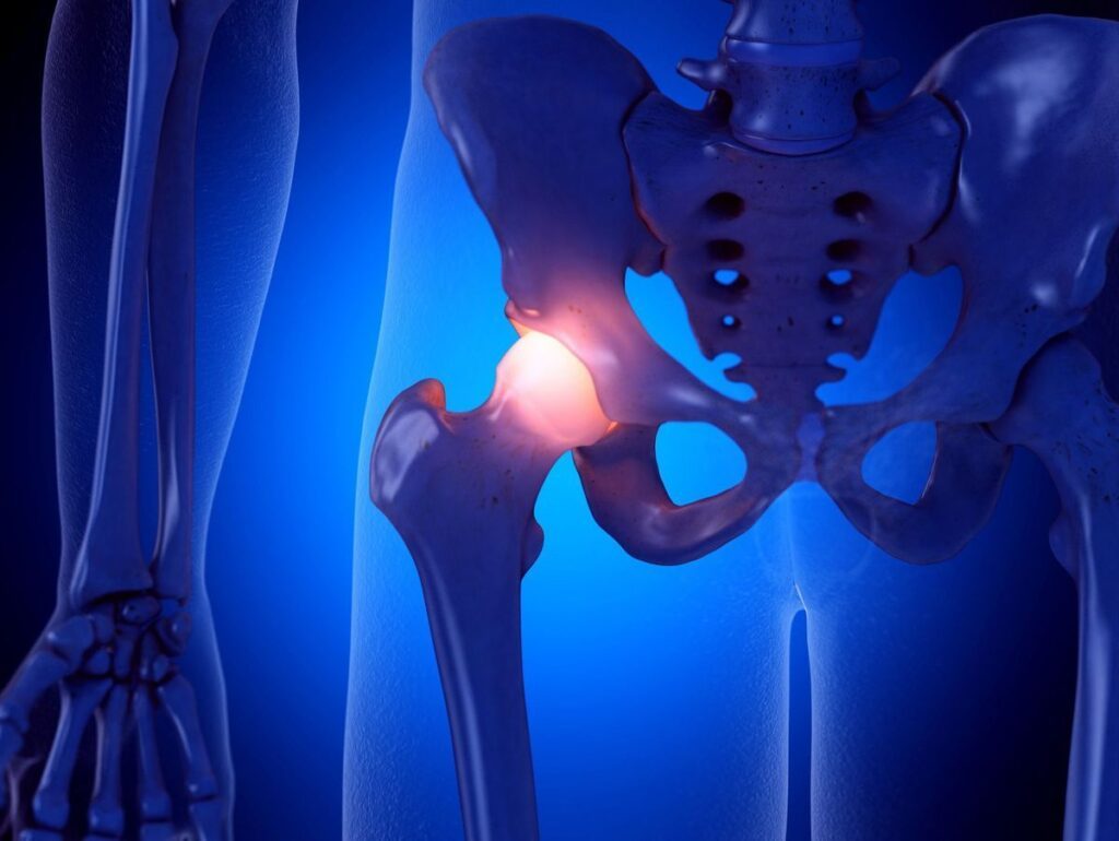 Les exercices de rééducation essentiels pour une fracture du fémur