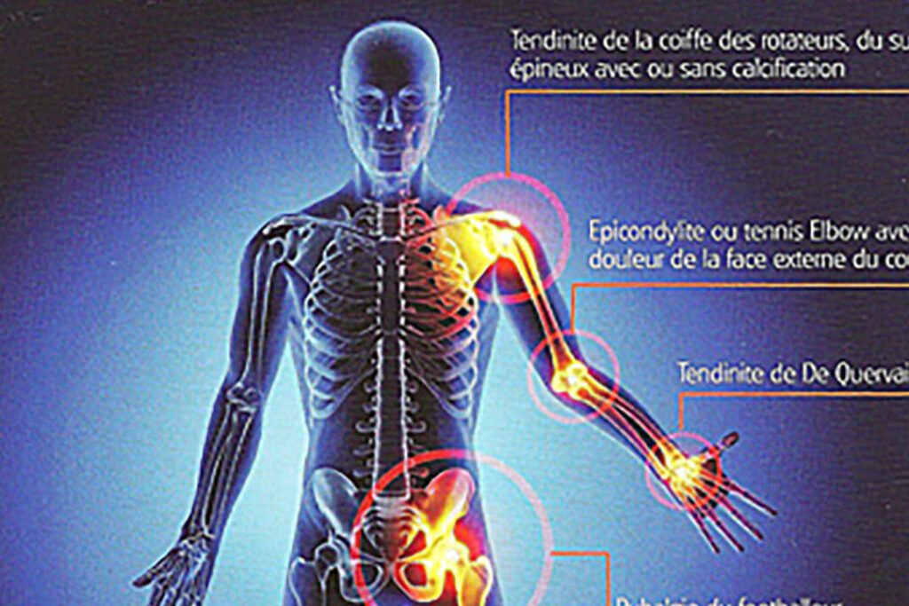Arrêt de Travail en raison d’une Tendinite de la Hanche: Tout ce que vous devez savoir