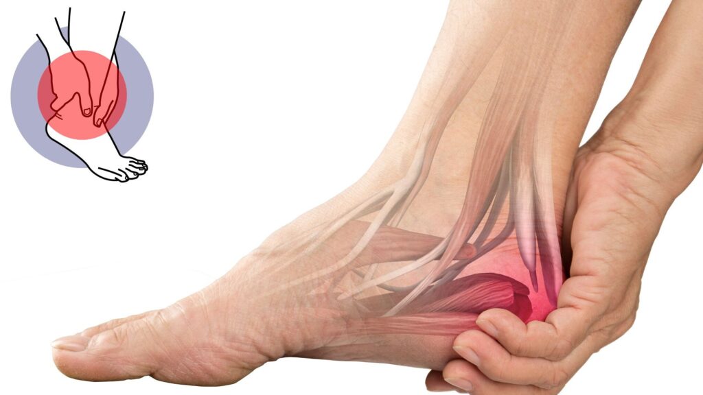 Comprendre et Traiter la Tendinite du Talon d&rsquo;Achille : Guide Pratique pour une Santé Optimale