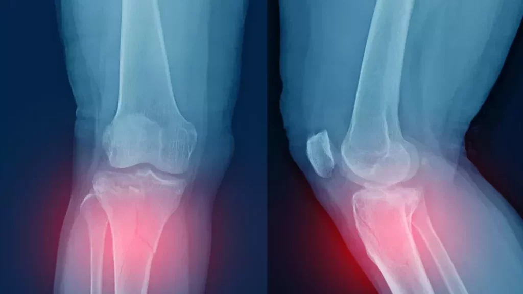 Comprendre la Douleur du Plateau Tibial : Causes, Symptômes et Traitements