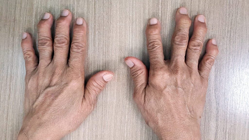 Comprendre la relation entre la maladie de Dupuytren et la polyarthrite : une approche globale de la santé des articulations