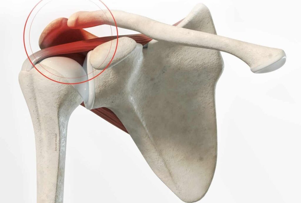 Comprendre l’Arthropathie Acromio Claviculaire et la Tendinite : Causes, Symptômes et Traitements
