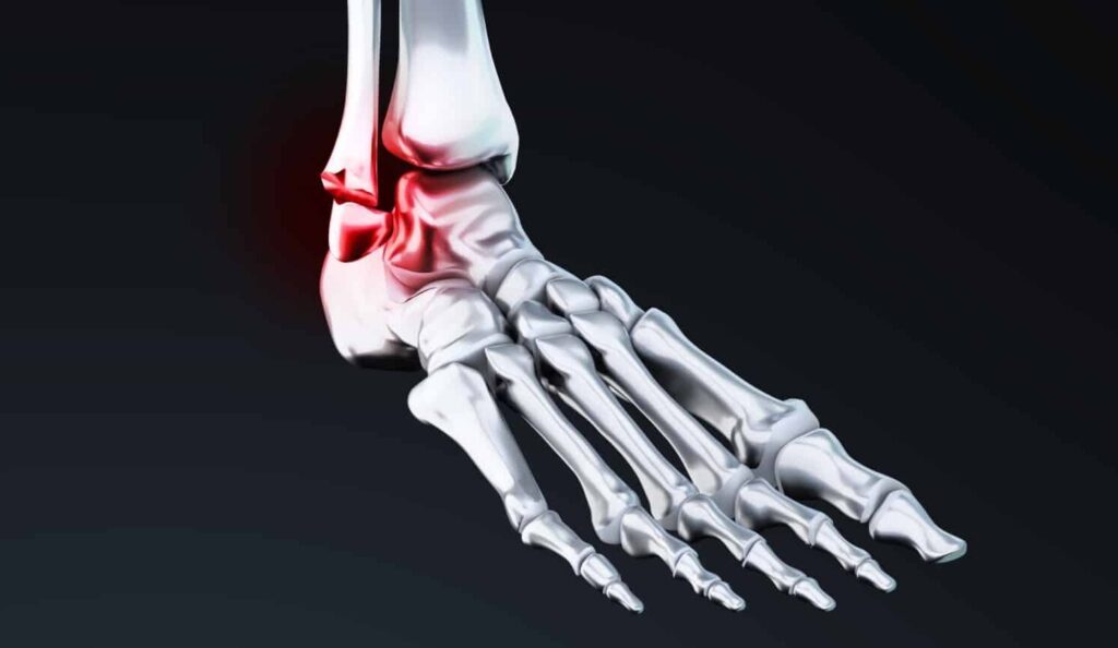 La Cicatrisation après une Ligamentoplastie de la Cheville: Ce que Vous Devez Savoir