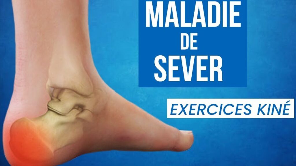 La kinésithérapie : un remède efficace contre la maladie de Sever
