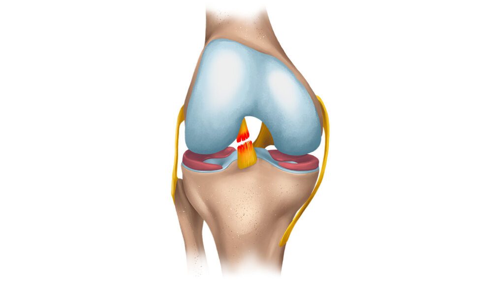 La Rupture du Ligament Croisé Antérieur : Découvrez le Temps de Guérison et les Facteurs Influents