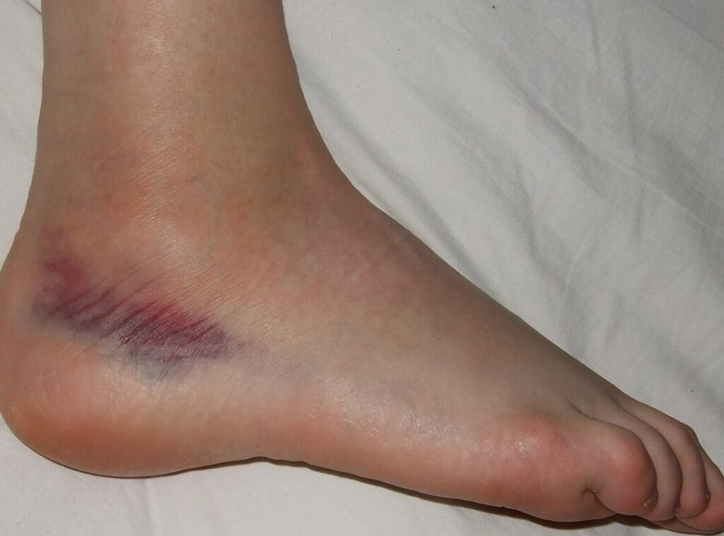 Les blessures de cheville les plus courantes chez les joueurs de football