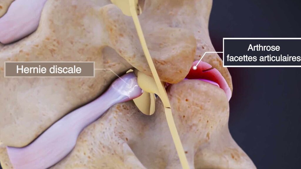 Névralgie cervicobrachiale : comprendre son trajet et ses implications