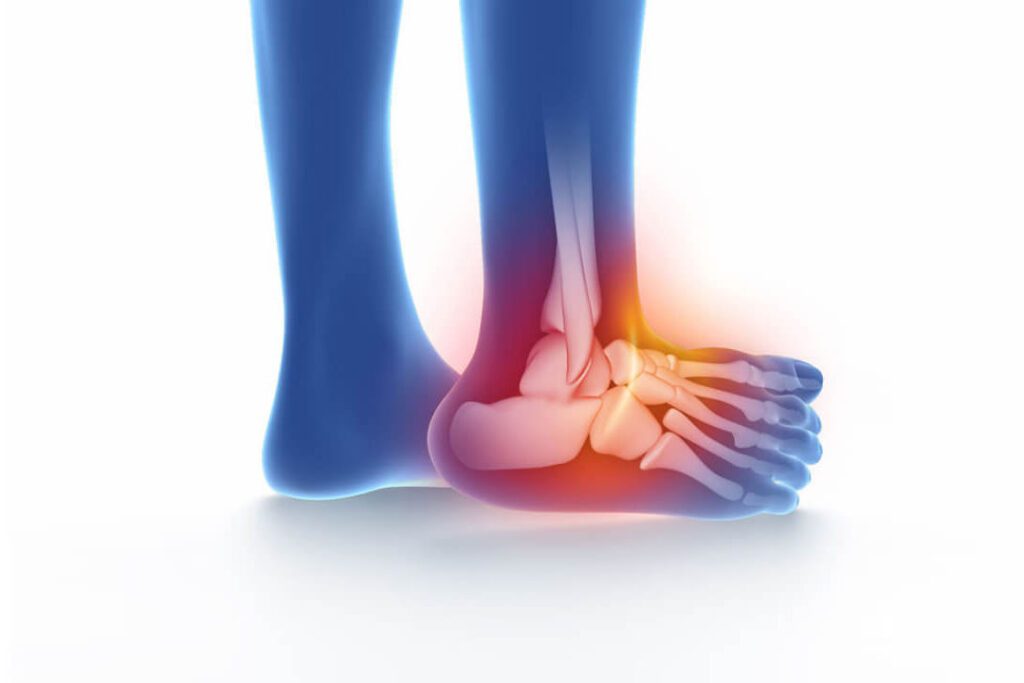 Rééducation après une Fracture de la Cheville : Conseils et Techniques pour une Recuperation Optimale