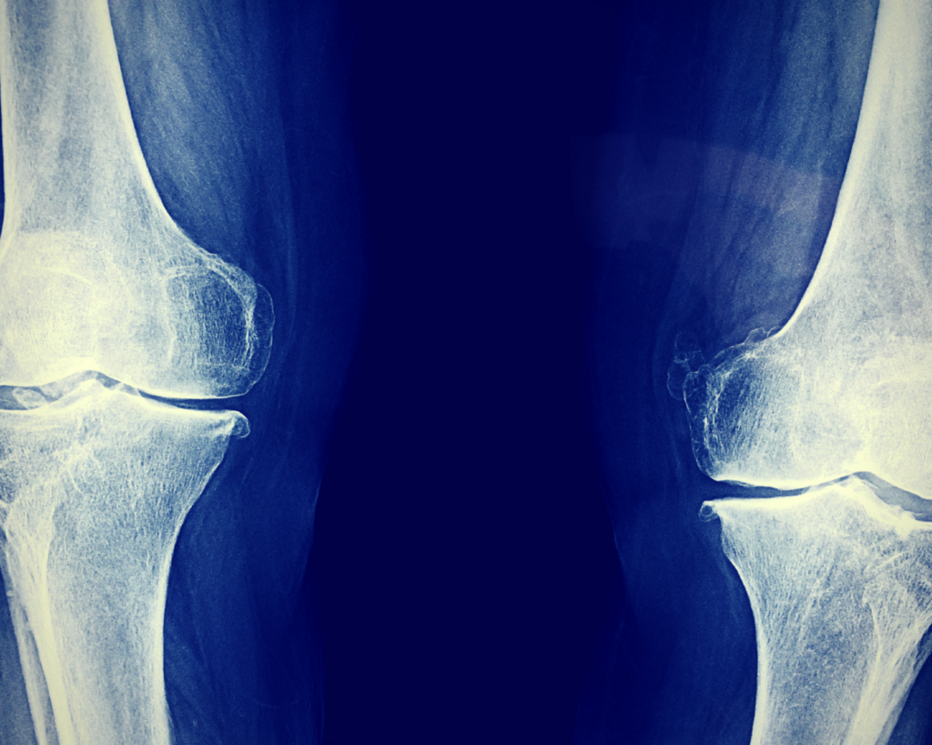 Traitement de la gonarthrose : l’importance de la kinésithérapie