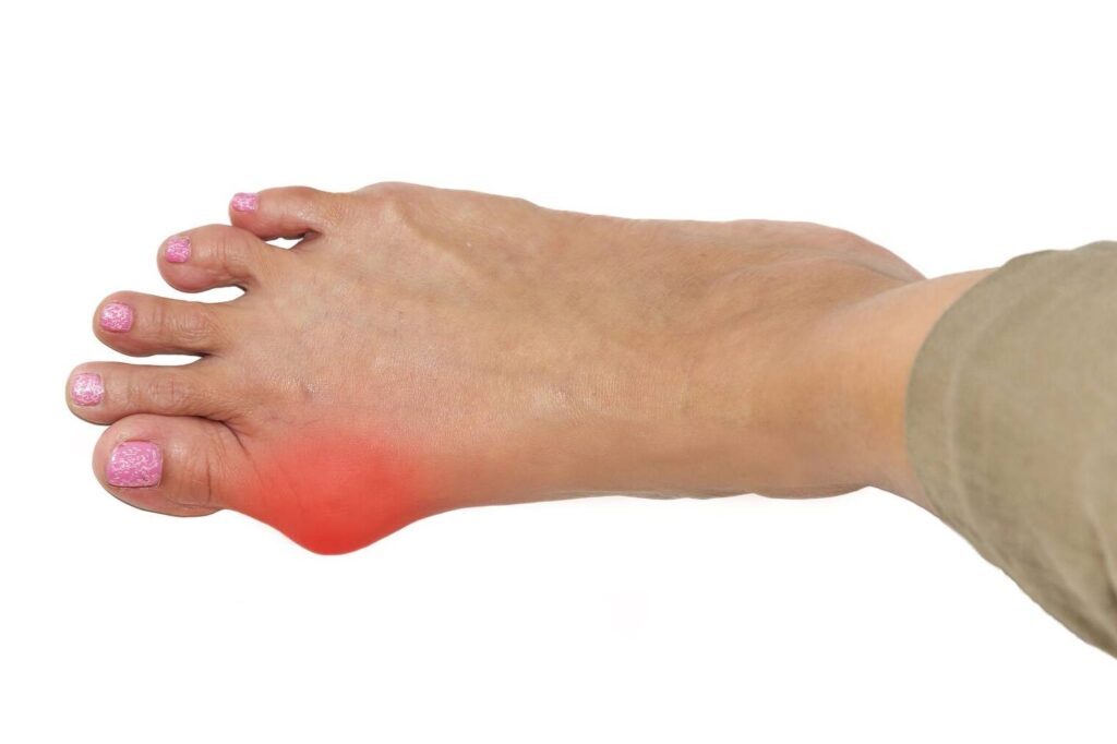 Traitements efficaces pour l’Hallux Valgus : Guide complet