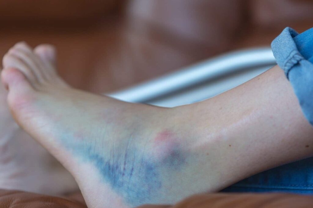 Arrachement osseux de la cheville : quel traitement suivre ?