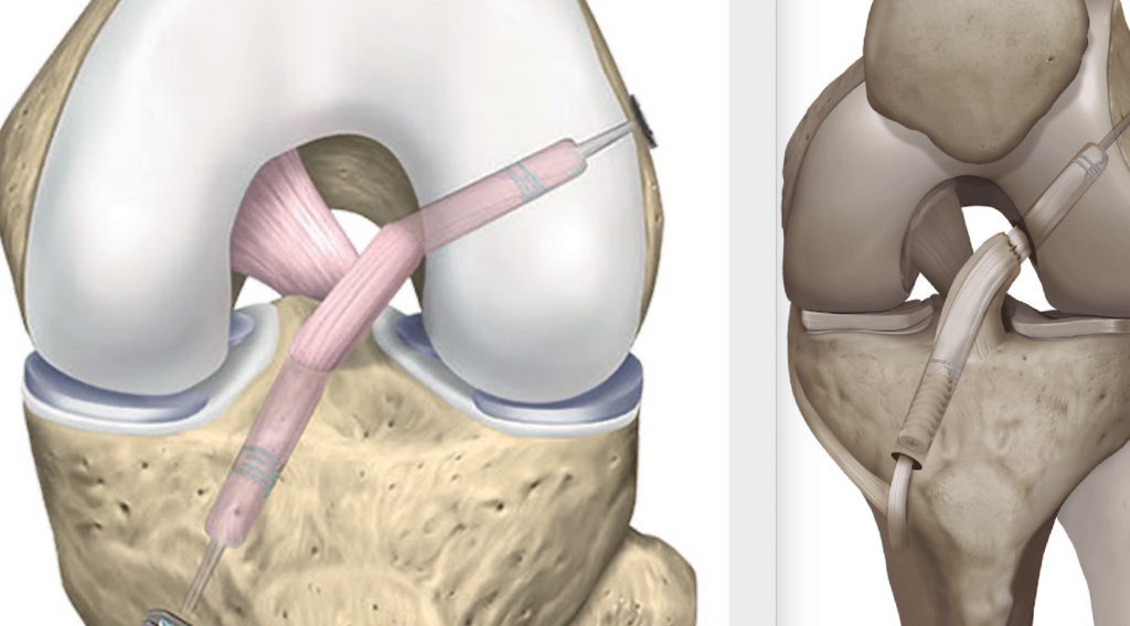 Ligamentoplastie du genou : guide complet de la récupération et des soins post-opératoires