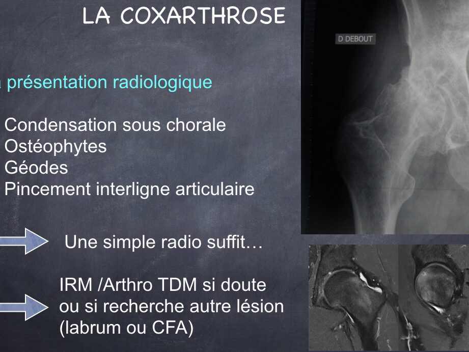 Quels sont les signes à rechercher sur une IRM de la hanche douloureuse ?