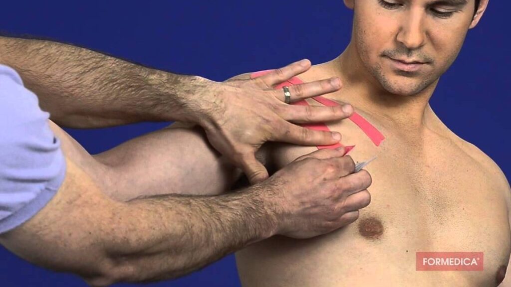 Strapping de l’épaule : est-ce efficace pour soulager une tendinite ?