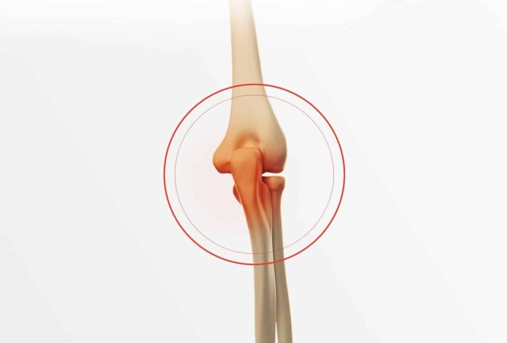 Comment soigner une fracture du radius et de l’ulna ?