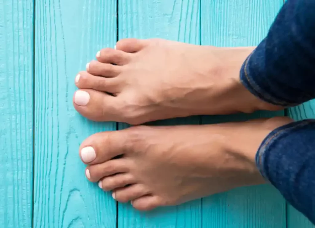 Hallux valgus modéré : comment le soulager sans chirurgie ?