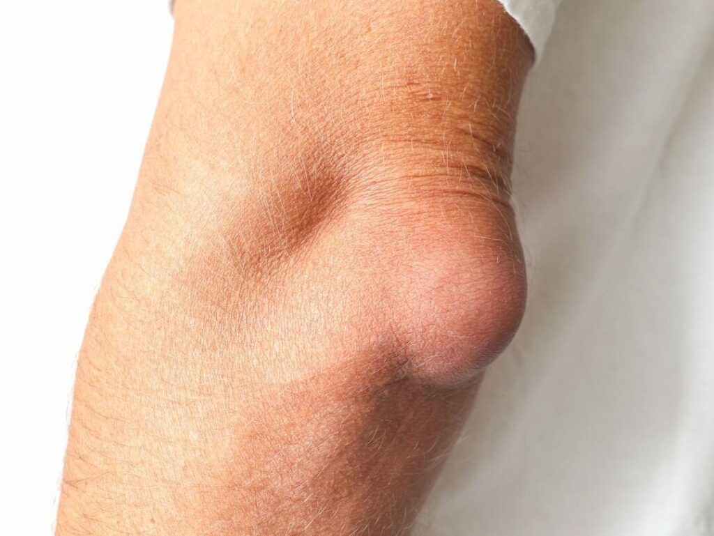 Hygroma du coude : quelles sont les causes principales ?