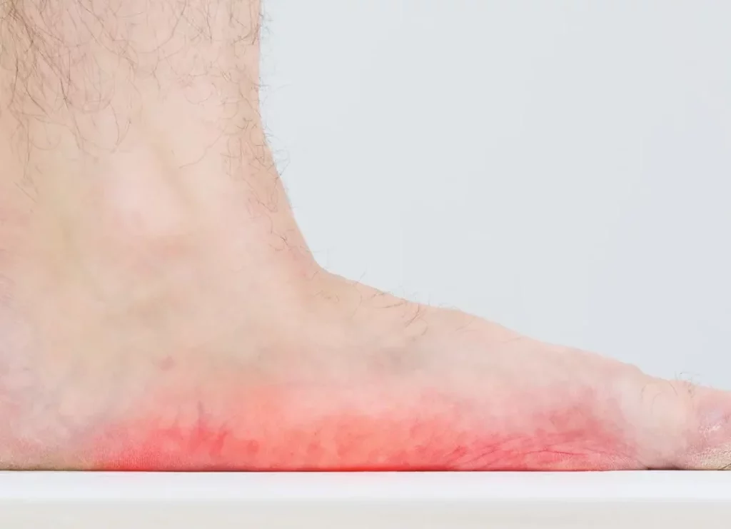 Comment reconnaître et traiter le problème de pied plat ?