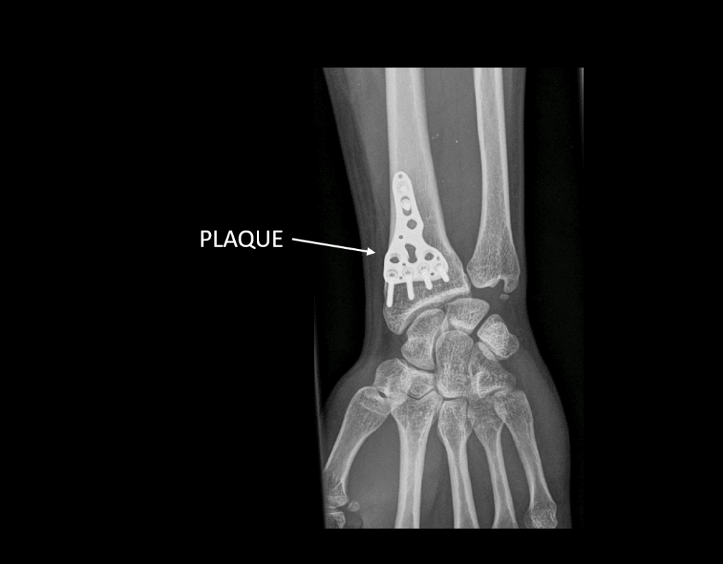 Fracture du radius : combien de temps pour une consolidation complète ?
