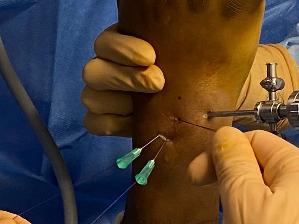 Comment se remettre d’une rupture des ligaments scapho-lunaire ?