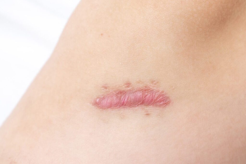 Comment soulager la douleur causée par une fibrose cicatricielle ?
