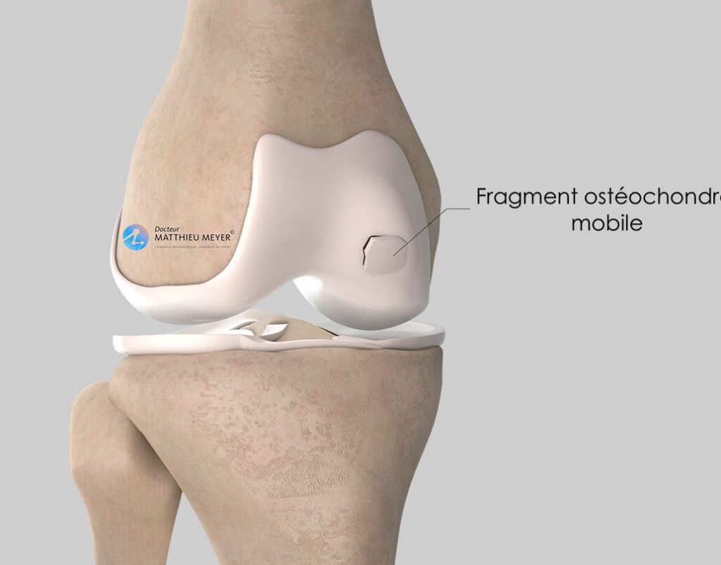 Comment traiter efficacement les problèmes de cartilage du genou ?