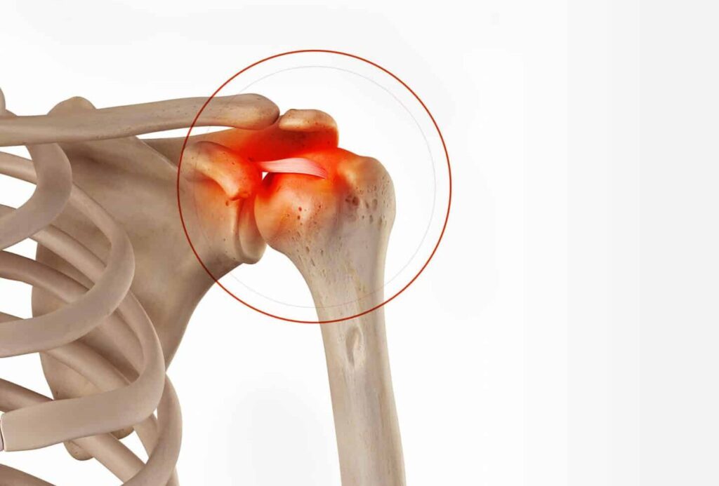 Lesion slap de l’épaule : comment la reconnaître et la traiter ?