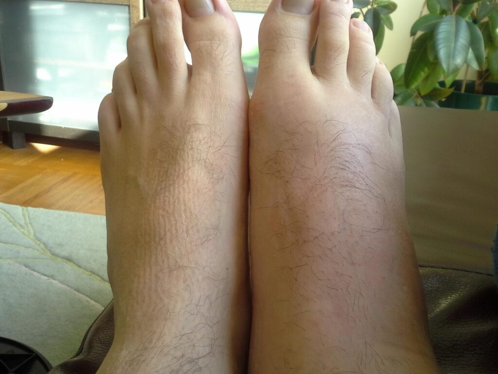 Rééducation après une blessure de Lisfranc: Comment retrouver sa mobilité ?