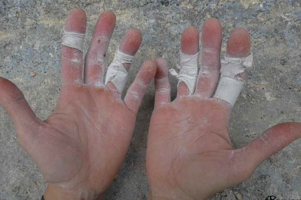 Pourquoi les blessures aux ligaments des doigts ne doivent pas être prises à la légère ?
