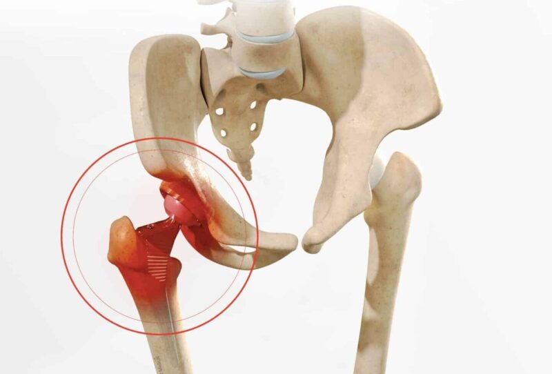 Reconnaître les symptômes d&rsquo;usure de votre prothèse de hanche : quand consulter ?