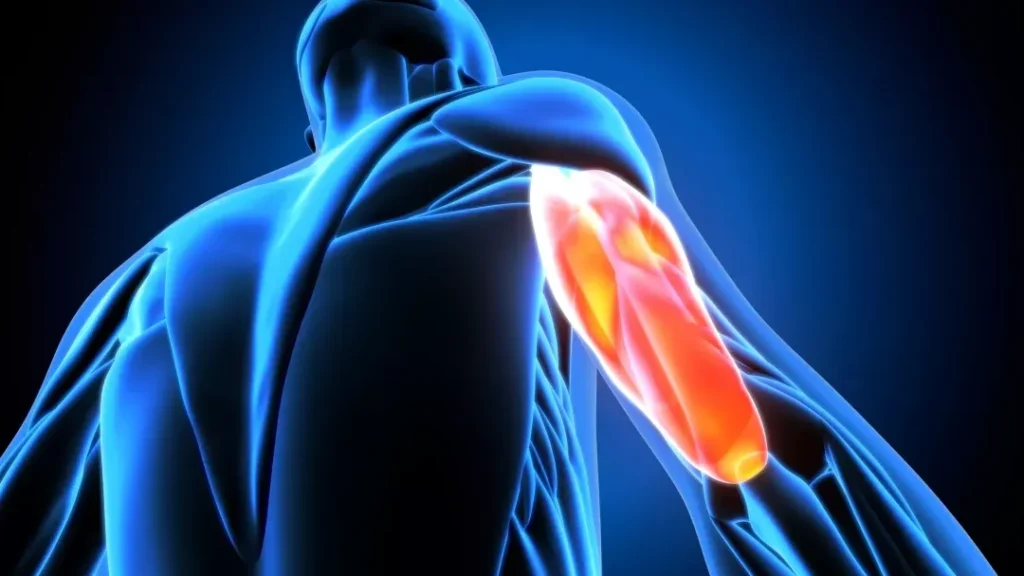 Comment se remettre d’une déchirure musculaire au triceps ?