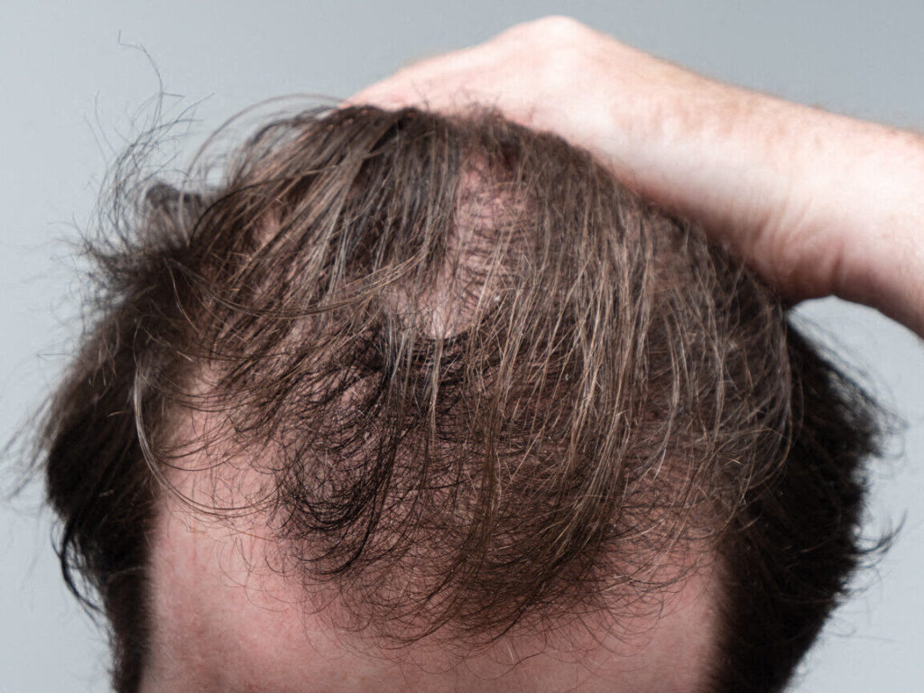 Perdre ses cheveux est ce vraiment une fatalité ?