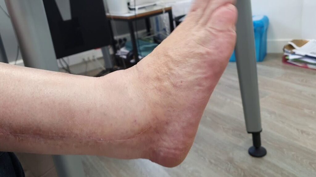 Peut-on courir avec une arthrodèse de la cheville ?