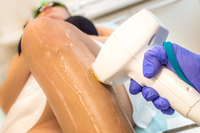 épilation laser jambe