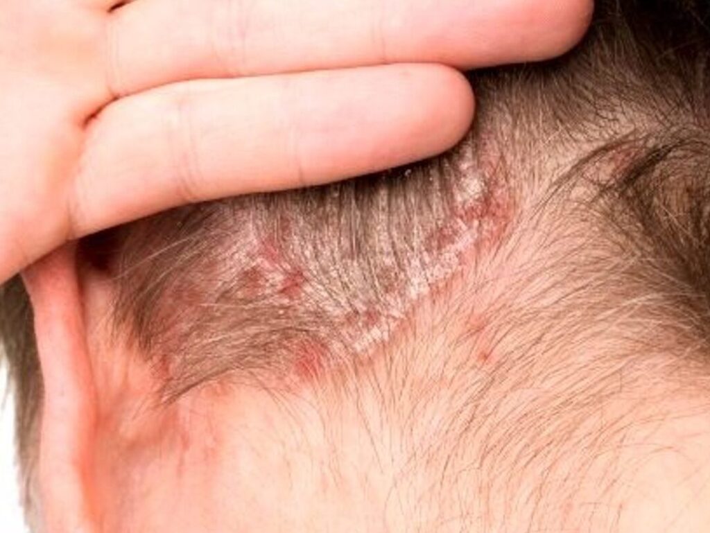 Allergie du cuir chevelu : comment reconnaître les symptômes et agir ?