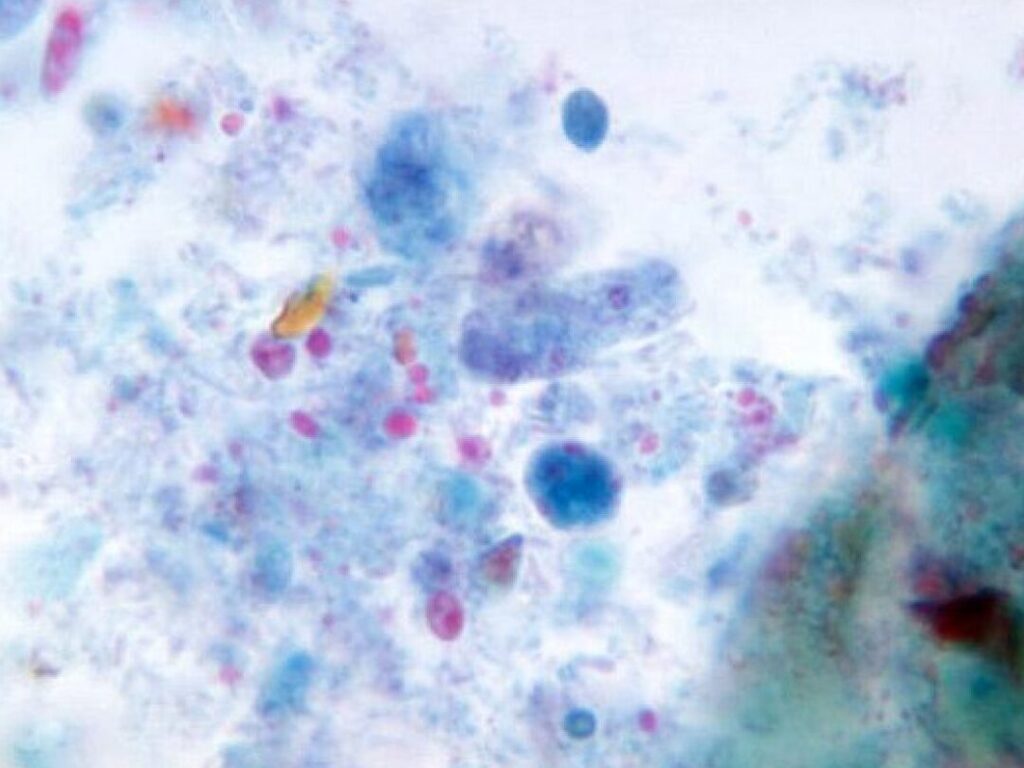 Comment traiter efficacement la dientamoeba fragilis ?