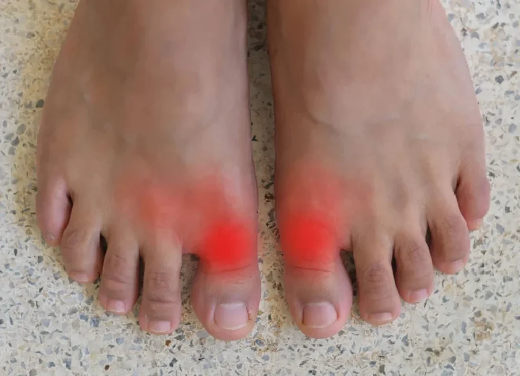 Comment une orthèse d&rsquo;orteil peut-elle soulager les douleurs de pied ?