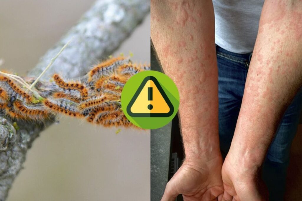 Piqûre de chenille processionnaire: comment réagir et traiter les démangeaisons ?