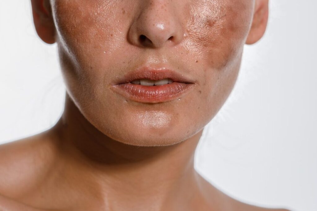 Comment prévenir et traiter les taches de grossesse dues au soleil ?