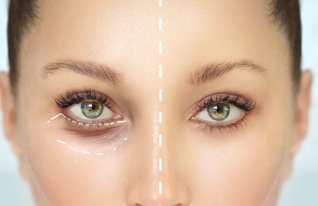 Comment réduire les poches et cernes sous les yeux efficacement ?