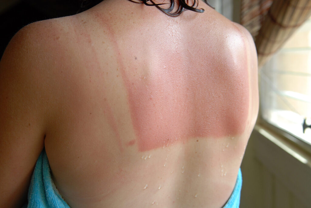 Comment soulager rapidement les démangeaisons d’un coup de soleil ?
