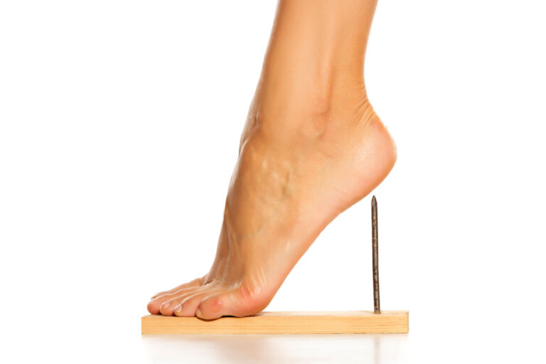 Femme touchant son talon pour illustrer la douleur causée par une aponévrosite plantaire persistante
