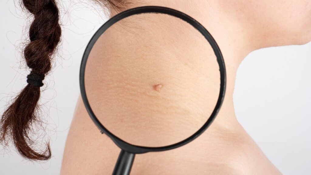 Bouton persistant sur la peau, l'un des signes courants d'un carcinome basocellulaire.