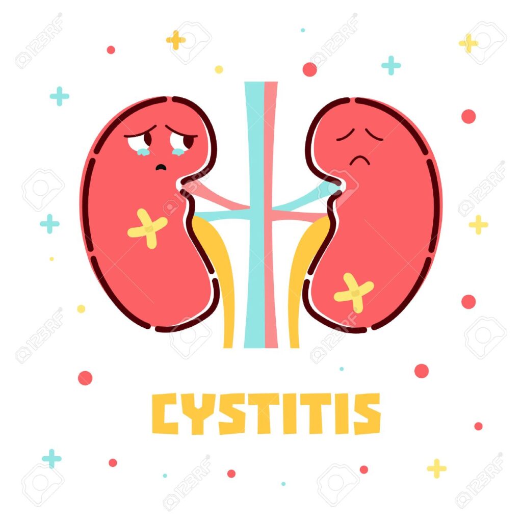 Illustration d'une vessie enflammée avec un visage triste, représentant la douleur et l'inconfort de la cystite.