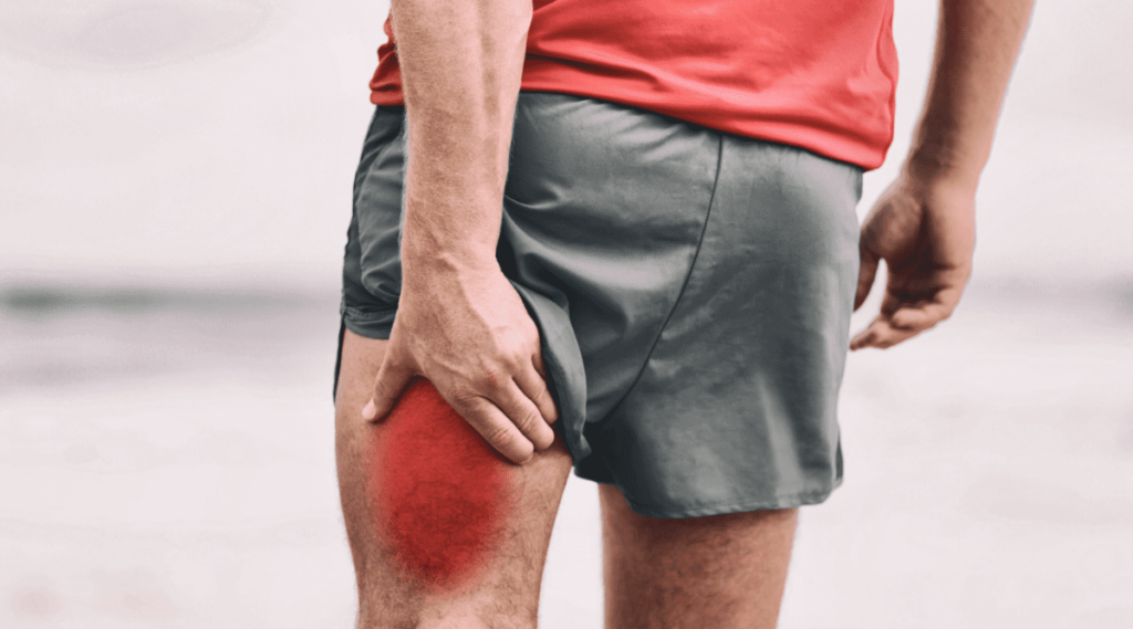 Illustration des douleurs du nerf sciatique affectant la jambe gauche